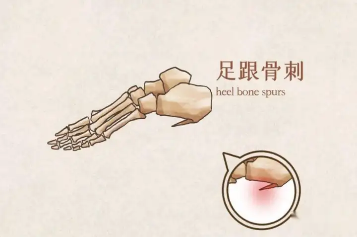 骨刺特效方,各种骨质增生特效根治秘方千万别错(图2)