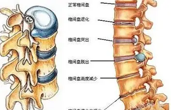 怎样治疗骨质增生？(图2)