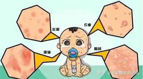 得了湿疹怎么办？邓主任教你如何治疗！(图1)