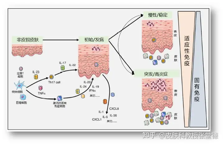 银屑病怎么治疗？皮肤科教授来解答(图2)