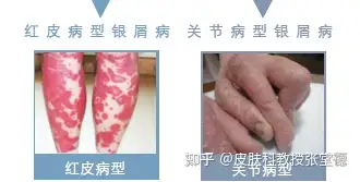 银屑病怎么治疗？皮肤科教授来解答(图4)