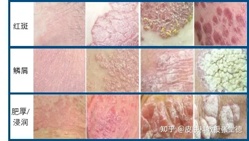 银屑病怎么治疗？皮肤科教授来解答(图6)