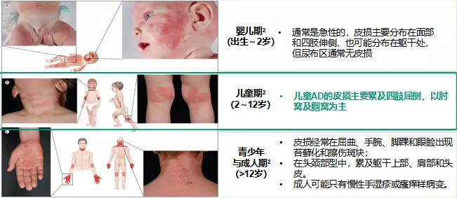 健康科普丨特应性皮炎治疗新进展高中生“低分(图5)