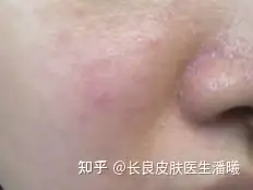 科普 | 脂溢性皮炎（多油 泛红 脱屑？）(图4)