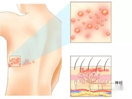 公布一个治疗带状疱疹的祖传秘方，简单易学，(图2)