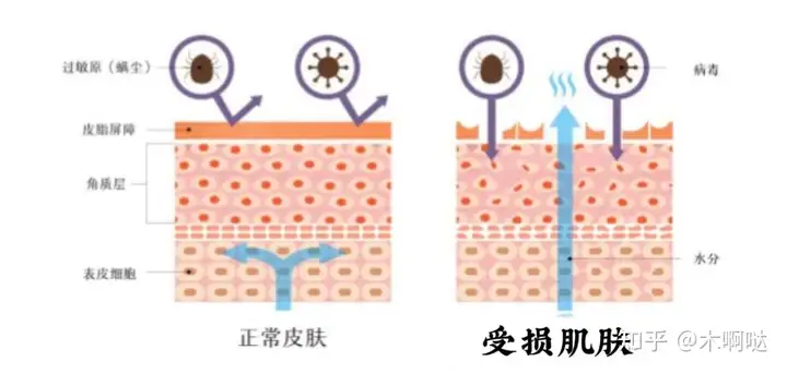 酒糟鼻能自己好吗？方法分享，不用去医美(图2)