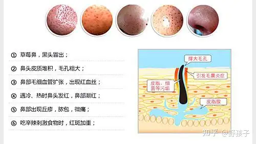 酒糟鼻有什么好的治疗方法？(图1)