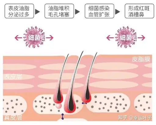 酒糟鼻怎么治？(图1)