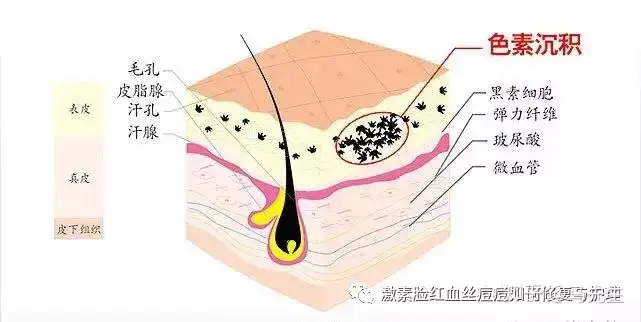 海英：什么是色素沉着？如何预防治？(图1)