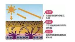 想要祛斑？先要预防黑色素沉着(图5)