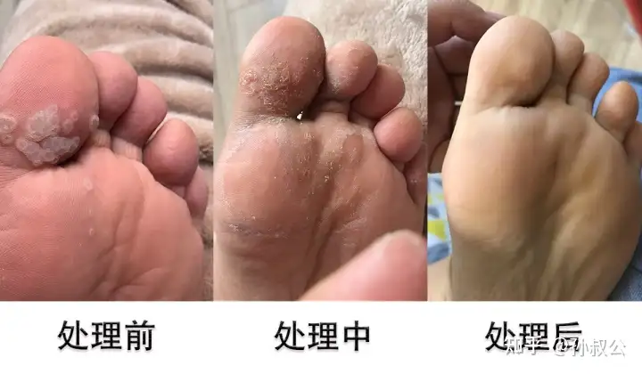 脚上长病毒疣怎么治？(图4)