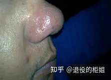 如何防止长黑头？(图3)