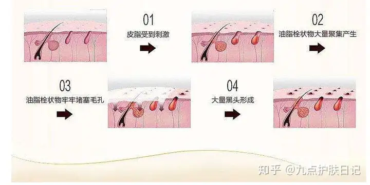 黑头到底该如何预防与去除？(图9)