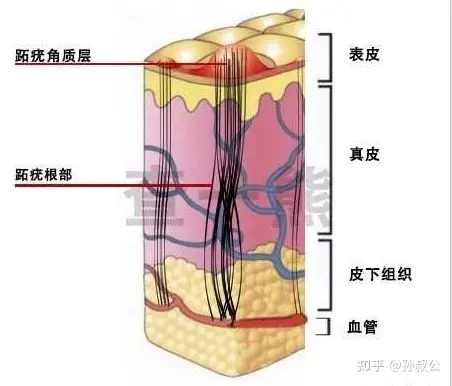 史上最硬核手足疣（跖疣、甲周疣）必看攻略-(图2)