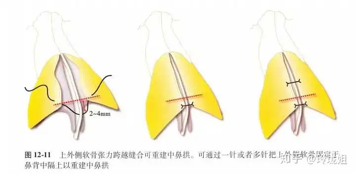 什么是鼻部整形手术？有哪些作用？(图1)