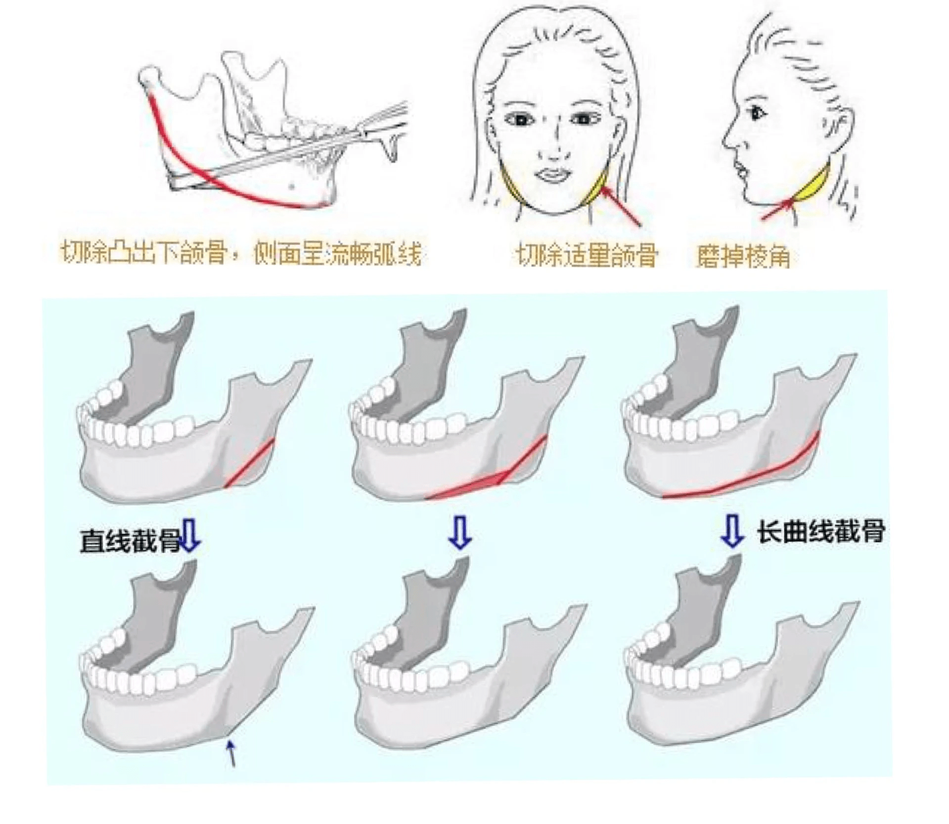 圣嘉新邱立东讲解：下颌角整形手术的费用大概(图2)