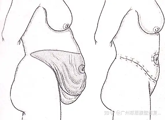 常见的腹壁整形手术方式是怎么操作的？适合什(图2)